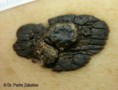 /album/fotogaleria/el-melanoma-jpg/